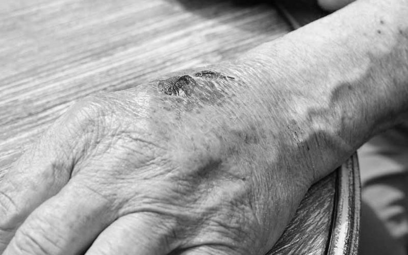 Elderly hand with sores